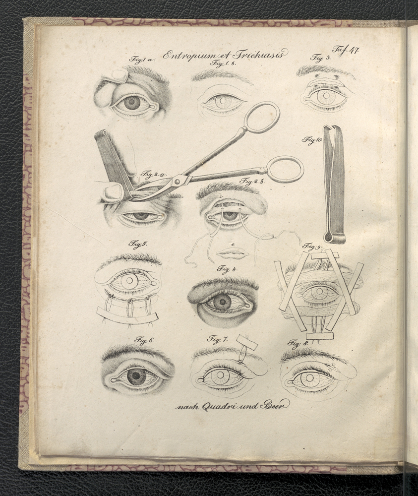 Zabiegi na powiekach oka – rycina poglądowa dla chirurgów, Chirurgische Lithographirte Tafeln…, Graetz 1827