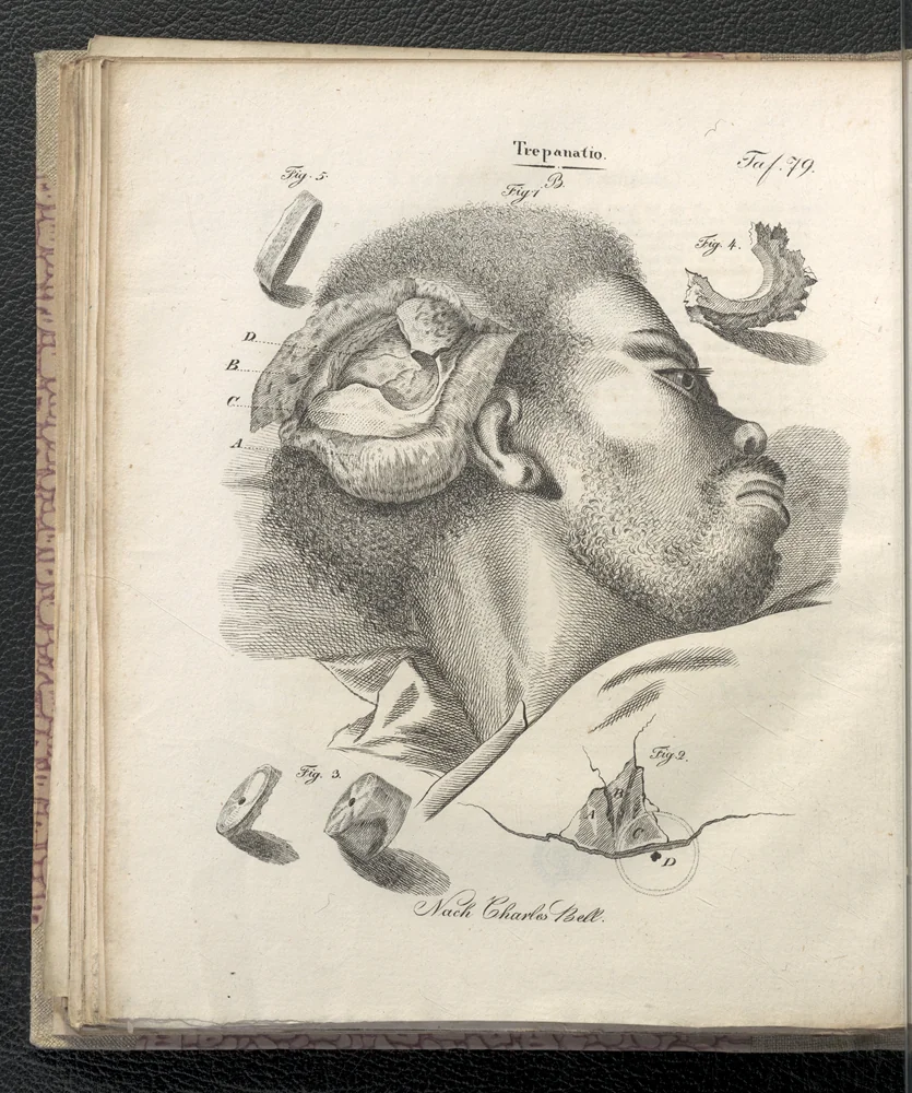 Trepanacja – rycina poglądowa dla chirurgów, Chirurgische Lithographirte Tafeln…, Graetz 1827